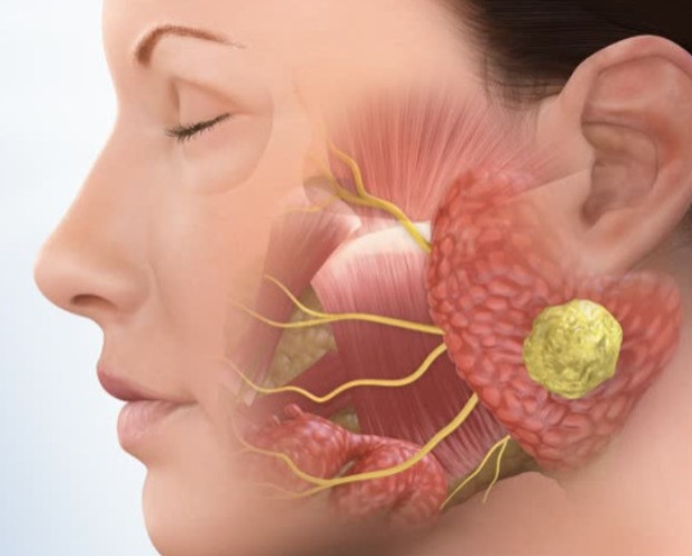 Parotid Cancer
